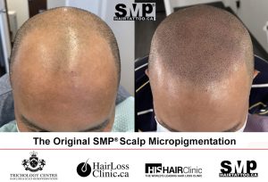 micro scalp pigmentation