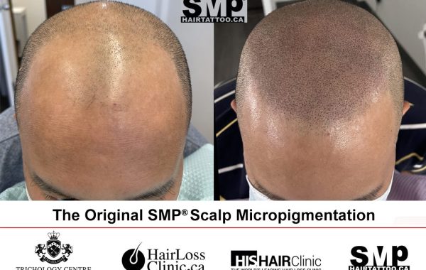 micro scalp pigmentation