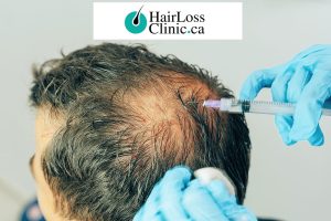 prp-hair-loss-treatment