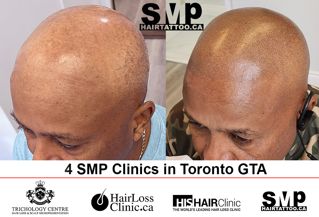 Reasons to Choose Scalp Micropigmentation in Fairfield CT