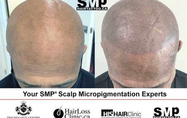 scalp micropigmentation Toronto Ontario