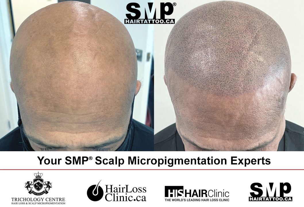 scalp micropigmentation Toronto Ontario
