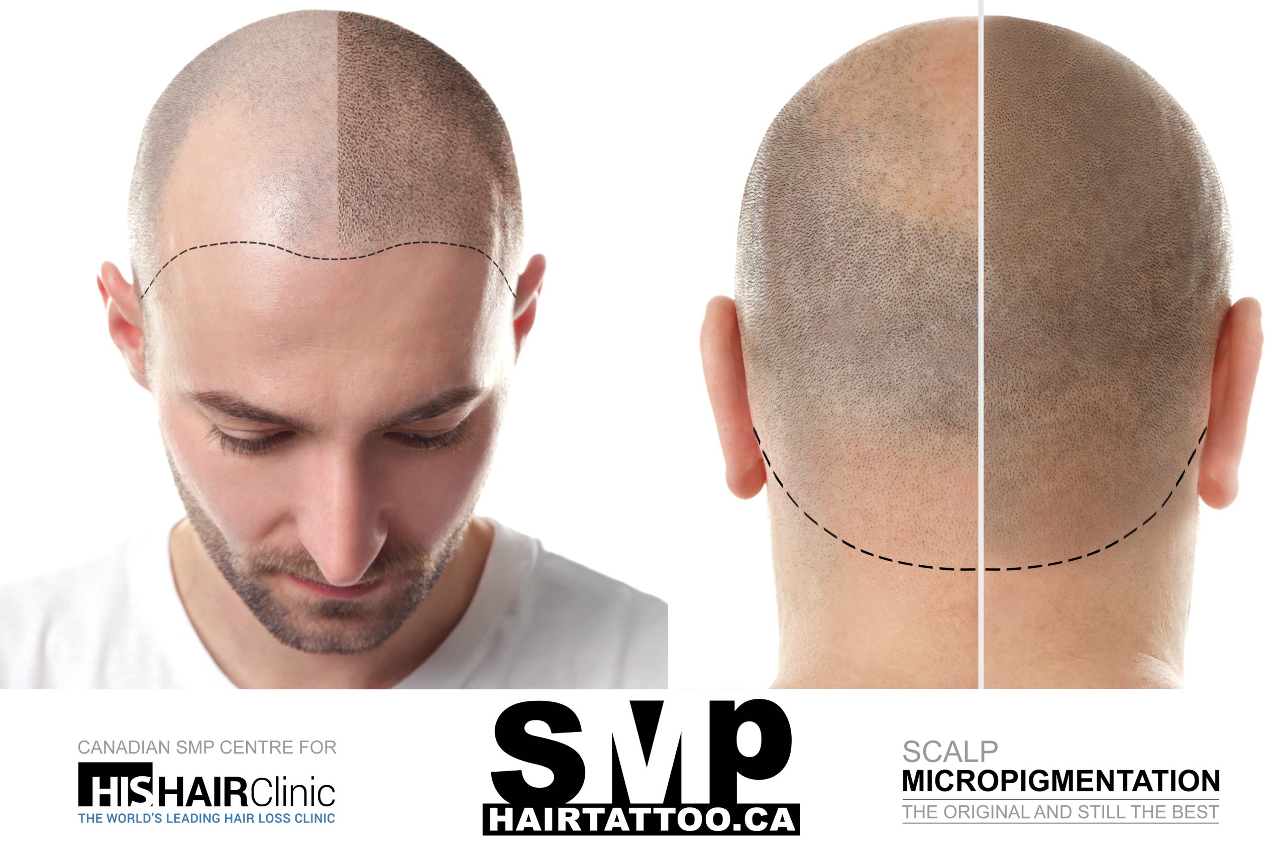 hairline tattoo -scalp micropigmentation Toronto – hair tattoo – micropigmentation scalp
