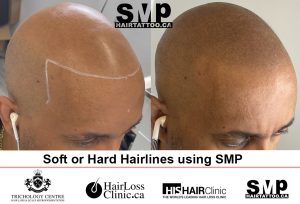 hair restoration - scalp micropigmentation regrets Toronto