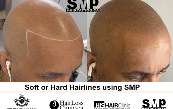 hair restoration - scalp micropigmentation regrets Toronto