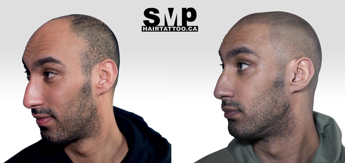 scalp micropigmentation - scalp micropigmentation Toronto - hair tattoo
