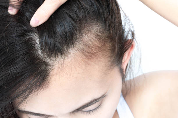 womens-hair-loss-telogen-effluvium