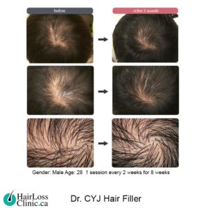 Dr. CYJ Hair Filler