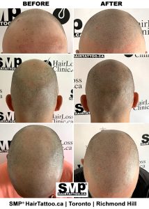 Hair Loss Treatment Scalp Micropigmentation Toronto 2