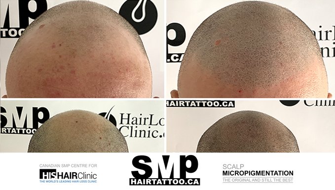 hairline tattoo - hair tattoo - scalp micropigmentation Toronto