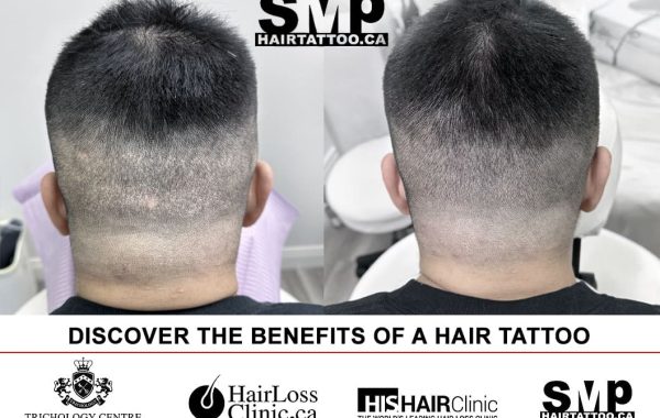 micropigmentation scalp Toronto