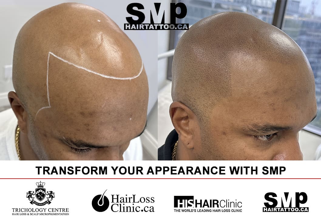 Leo Scalp Micropigmentation | Hornchurch