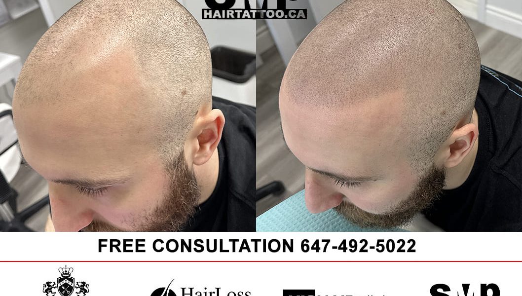 scalp micropigmentation Toronto hair tattoo