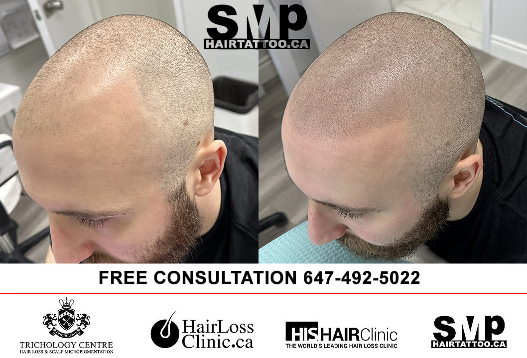 Realistic Hairline Tattoo | Scalp Micropigmentation SMP for Short/Shaved  Hair in Birmingham UK | Results & Process