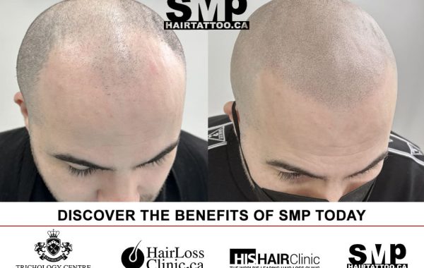 scalp micropigmentation regrets Toronto