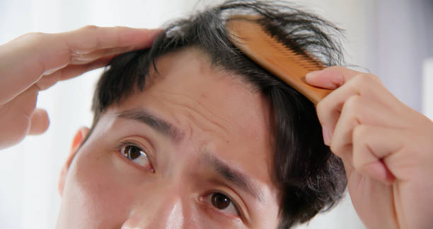 balding - baldness - androgenetic alopecia - hair loss treatment