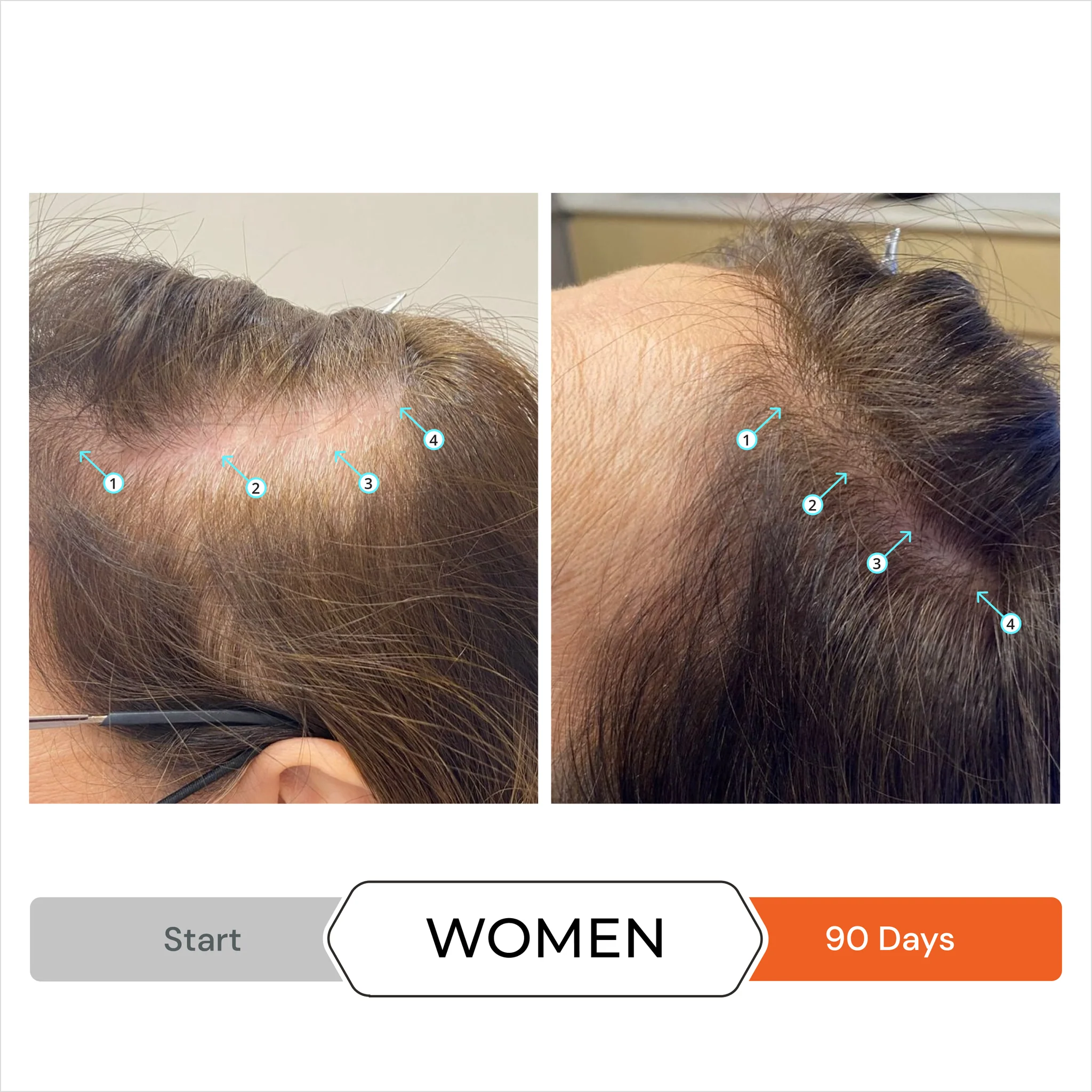 Hair Loss: Sasha Advanced Treatments To Stop Hair Loss and Boost