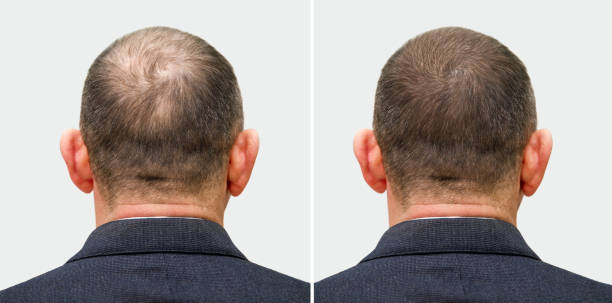 hair loss treatment - minoxidil Rogaine - finasteride - Propecia