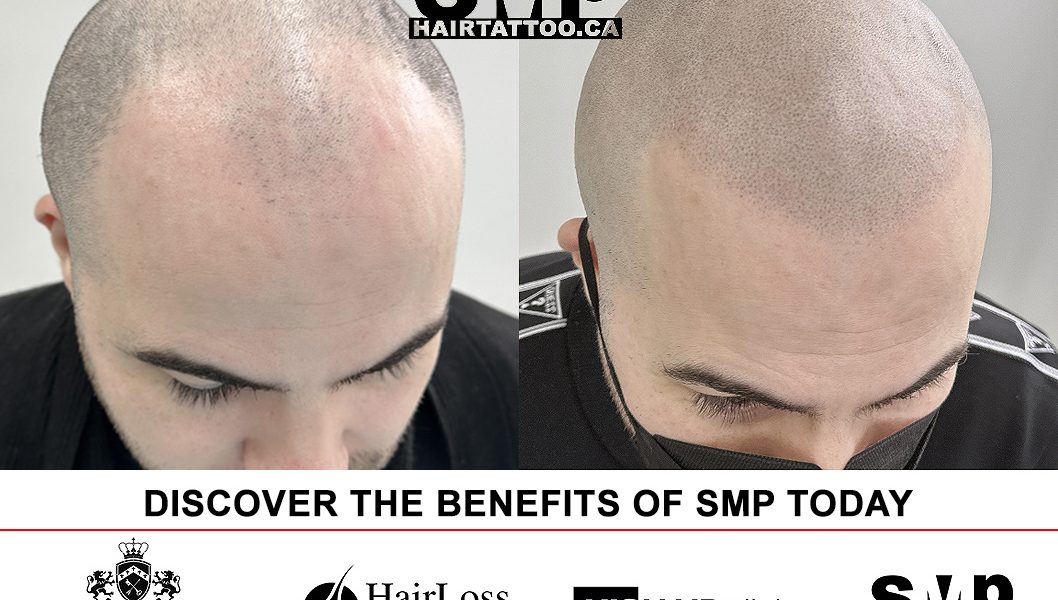 trichologist - SMP - Scalp micropigmentation - hair tattoo