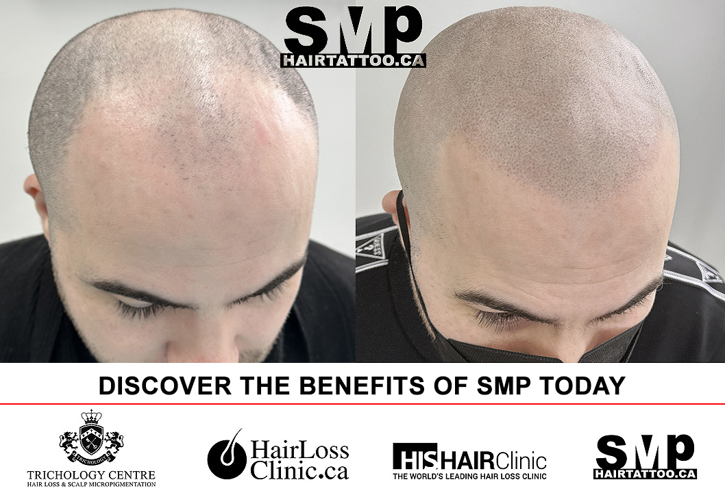 trichologist - SMP - Scalp micropigmentation - hair tattoo