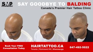 scalp micropigmentation - hair tattoo - hairline tattoo Toronto