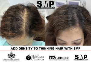 scalp-micropigmentation-women