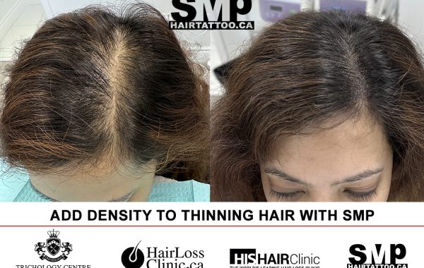 scalp-micropigmentation-women