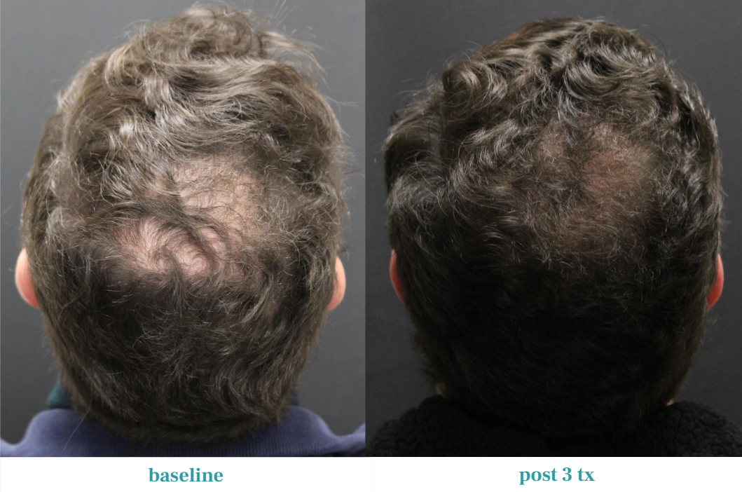 Alma Ted Revolutionizing Hair Loss Treatment With Ultrasound Technology