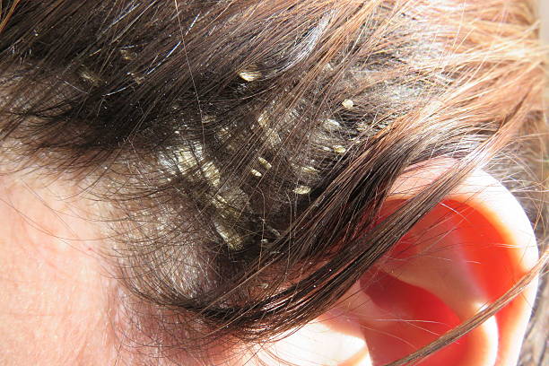 Understanding And Managing Dandruff Causes Symptoms And Effective