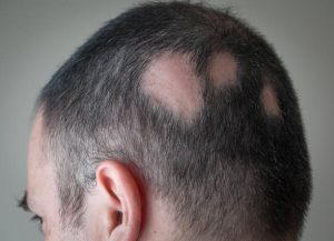 scarring alopecia - alopecia totalis - alopecia universalis