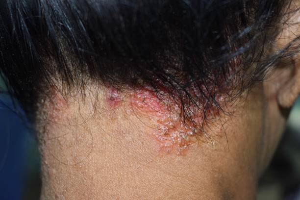 Seborrheic Dermatitis