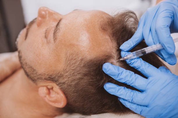 trichologist - PRP treatment - PRP hair treatment