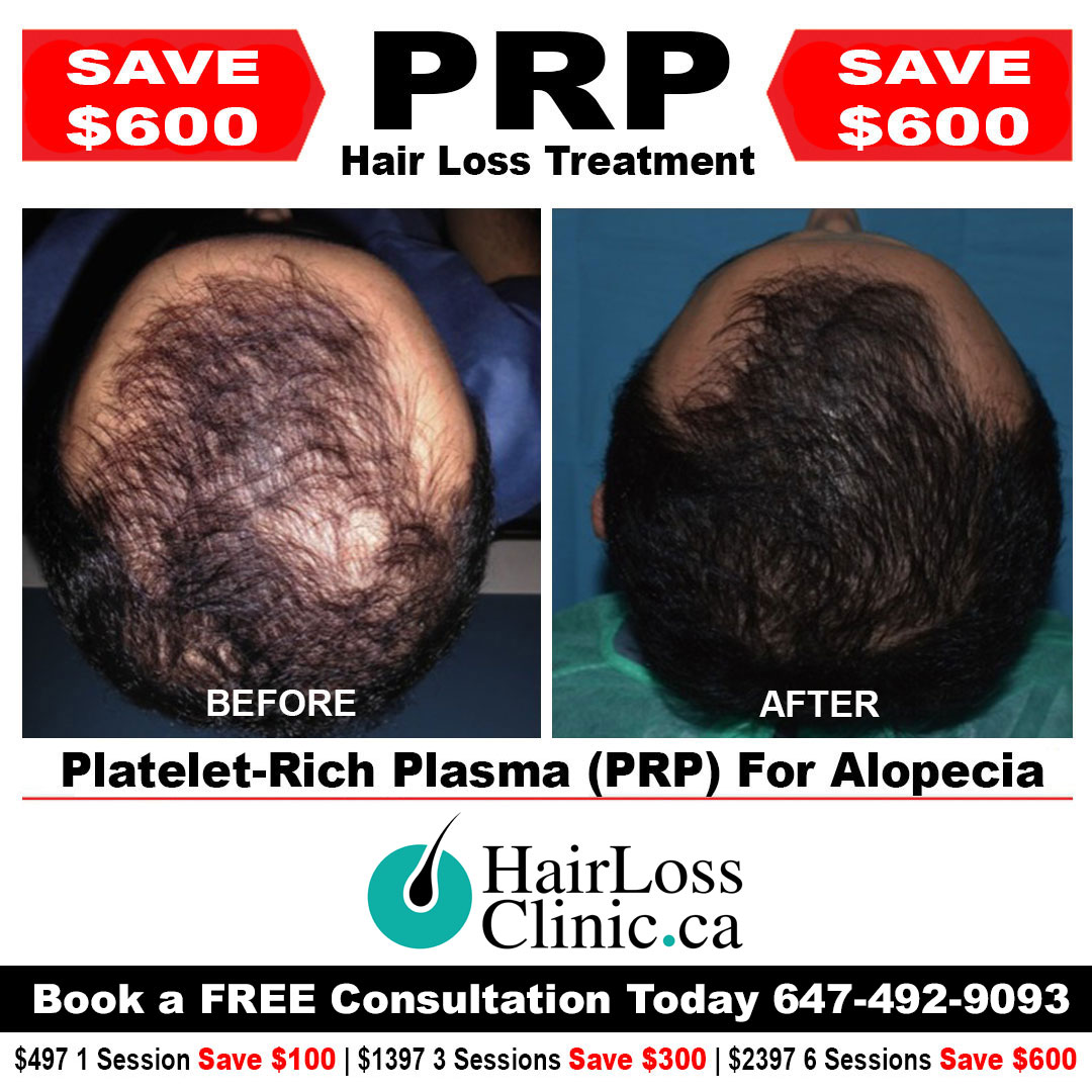 PRP hair treatment - PRP Toronto