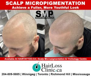 hair tattoo-hair transplant Winnipeg-scalp micropigmentation Winnipeg