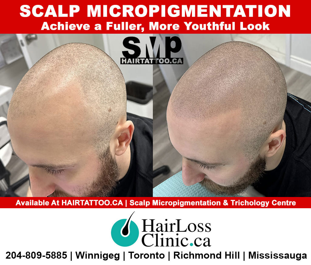 hair tattoo-hair transplant Winnipeg-scalp micropigmentation Winnipeg