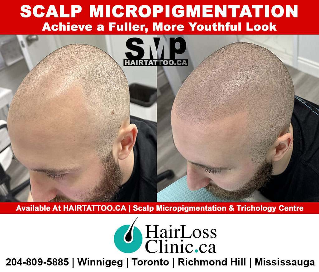 Scalp micropigmentation SMP (Head Hair replication tattooing) - DPC Clinic