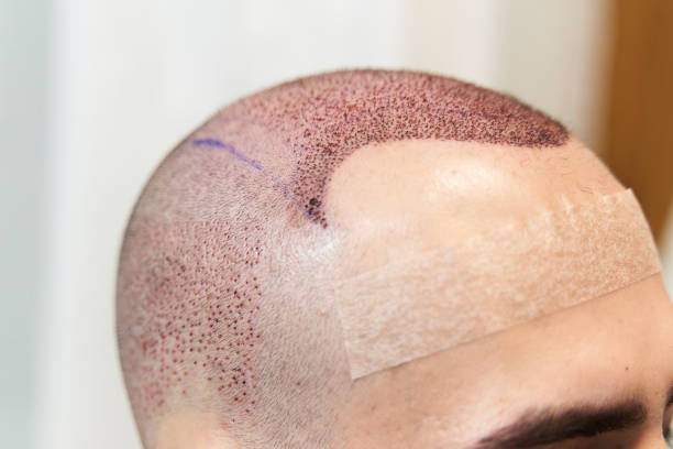 hair loss treatment - hair transplant - scalp reduction - FUT - FUE