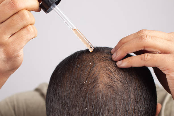 hair loss treatment - minoxidil Rogaine finasteride Propecia