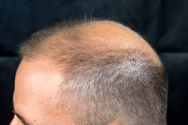 hair loss treatment