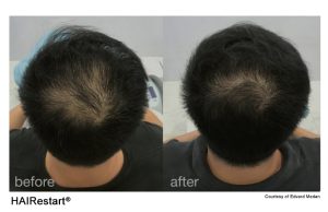 fotona-hairestart-hair-restart