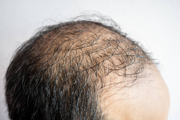 Hair Thinning On One Side of Head - Causes & Solutions – DS