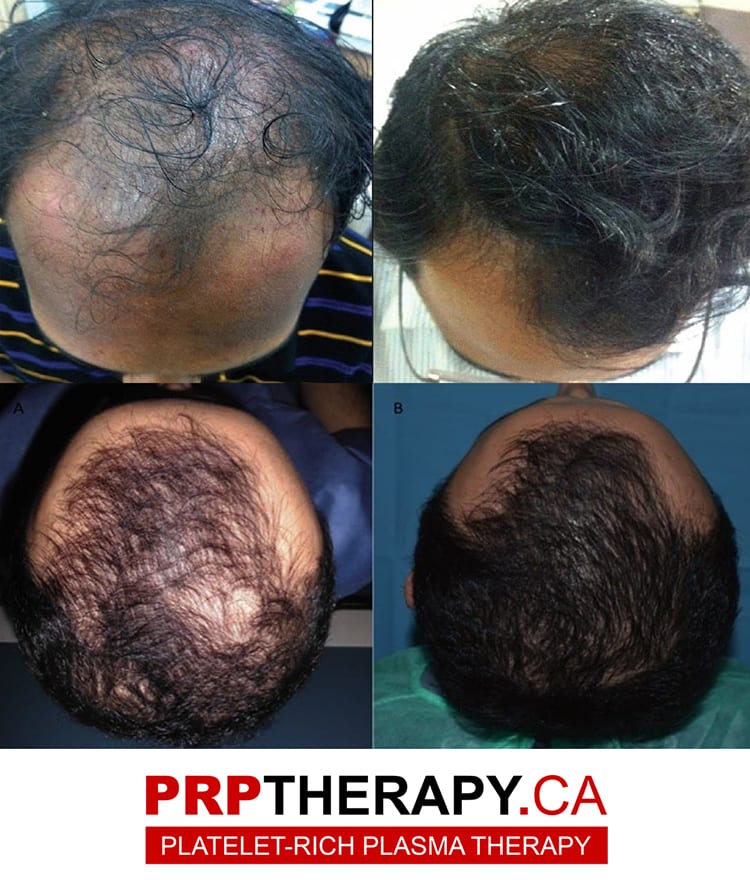 PRP hair loss treatment - PRP treatment
