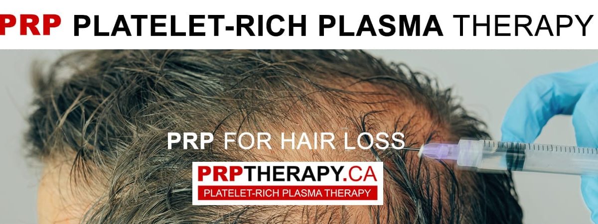 PRP hair treatment Niagara Falls