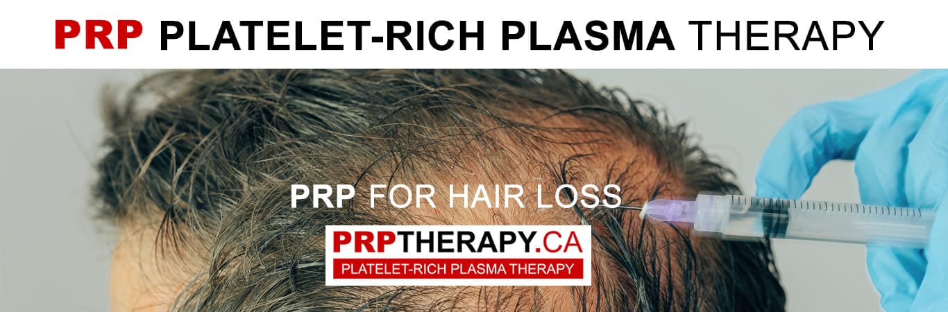 PRP hair treatment Niagara Falls