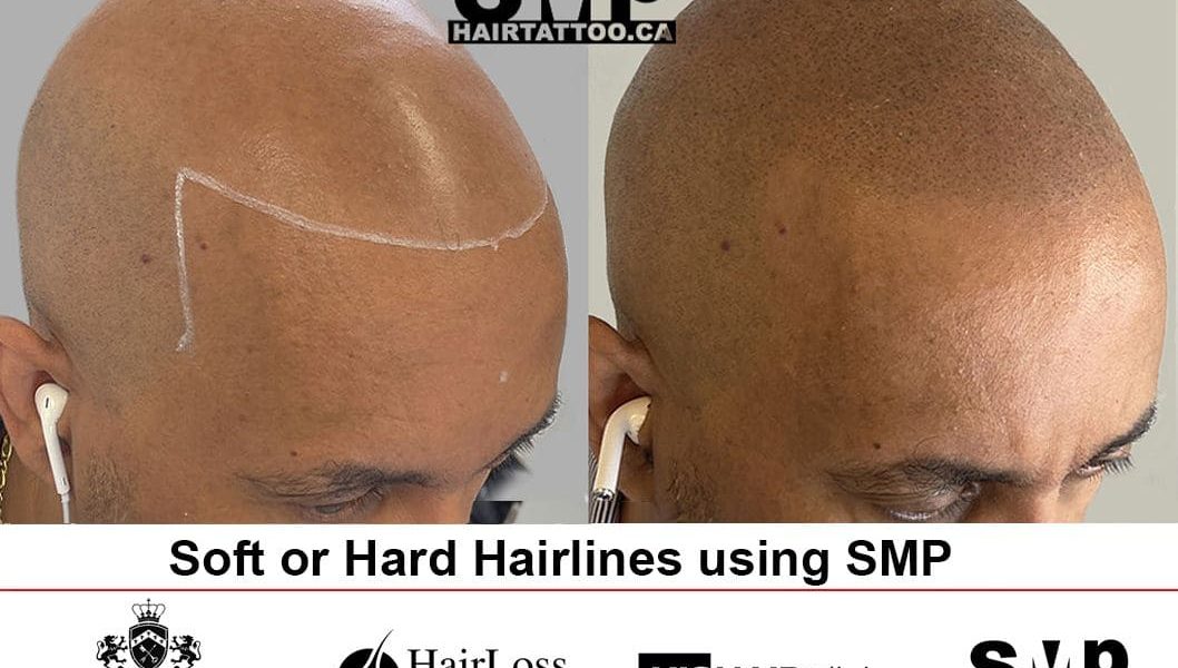 scalp-micropigmentation