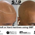 scalp-micropigmentation