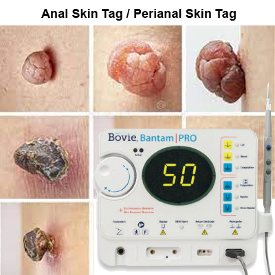 anal skin tag removal Toronto