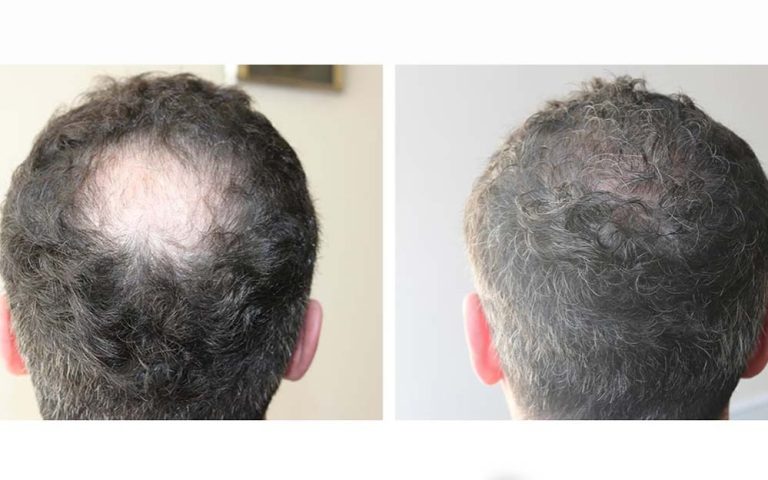 before and after hair transplant turkey