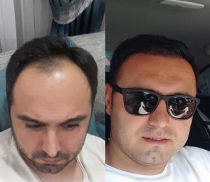 best fue hair transplant in turkey