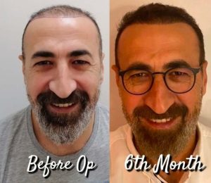 best hair transplant clinic turkey